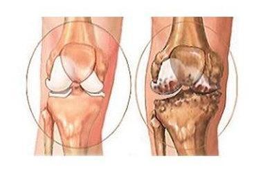 膝盖图位置图_膝盖各个部位疼痛图解分析_膝盖图解疼痛部位分析图片