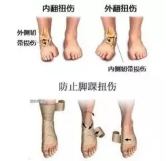 踝关节常见韧带损伤 踝部扭伤 踝部扭伤 踝关节常见韧带损伤 踝部扭伤 踝部扭伤
