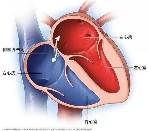 卵圆孔未闭图.jpg