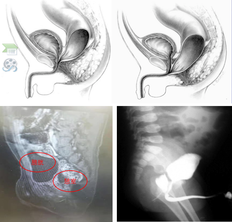 先天性肛门闭锁_先天性肛门闭锁治疗方式 - 好大夫在线
