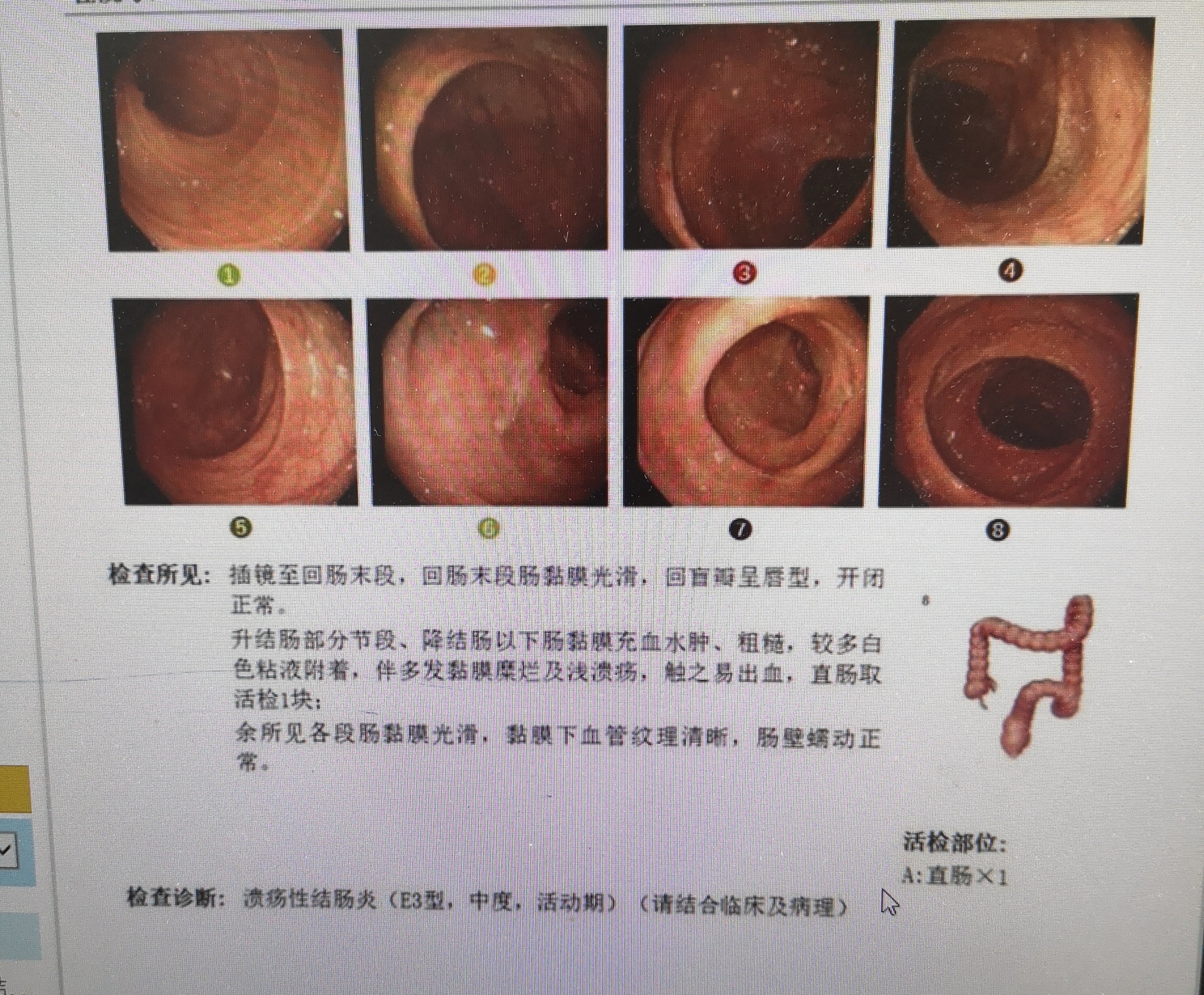 特效中药治疗全结肠型溃疡性结肠炎疗效证明