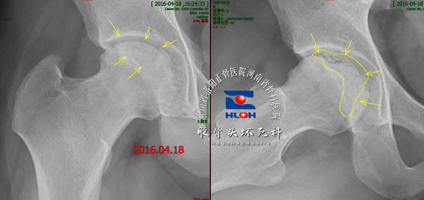 雙側股骨頭壞死植骨vs保守治療5年隨訪