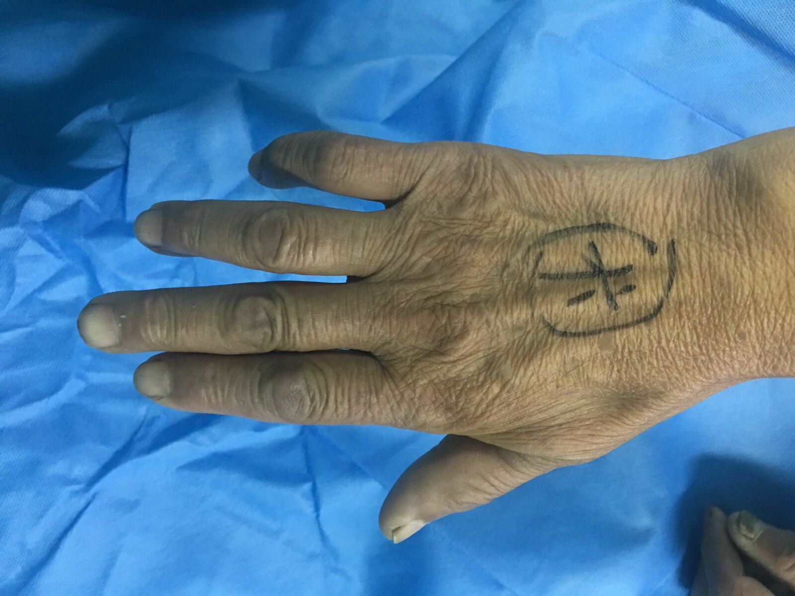 周围神经卡压之肘管综合征_肘管综合征 - 好大夫在线