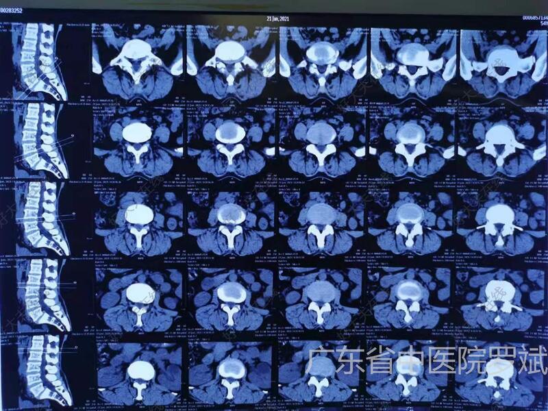 峽部裂型腰椎滑脫