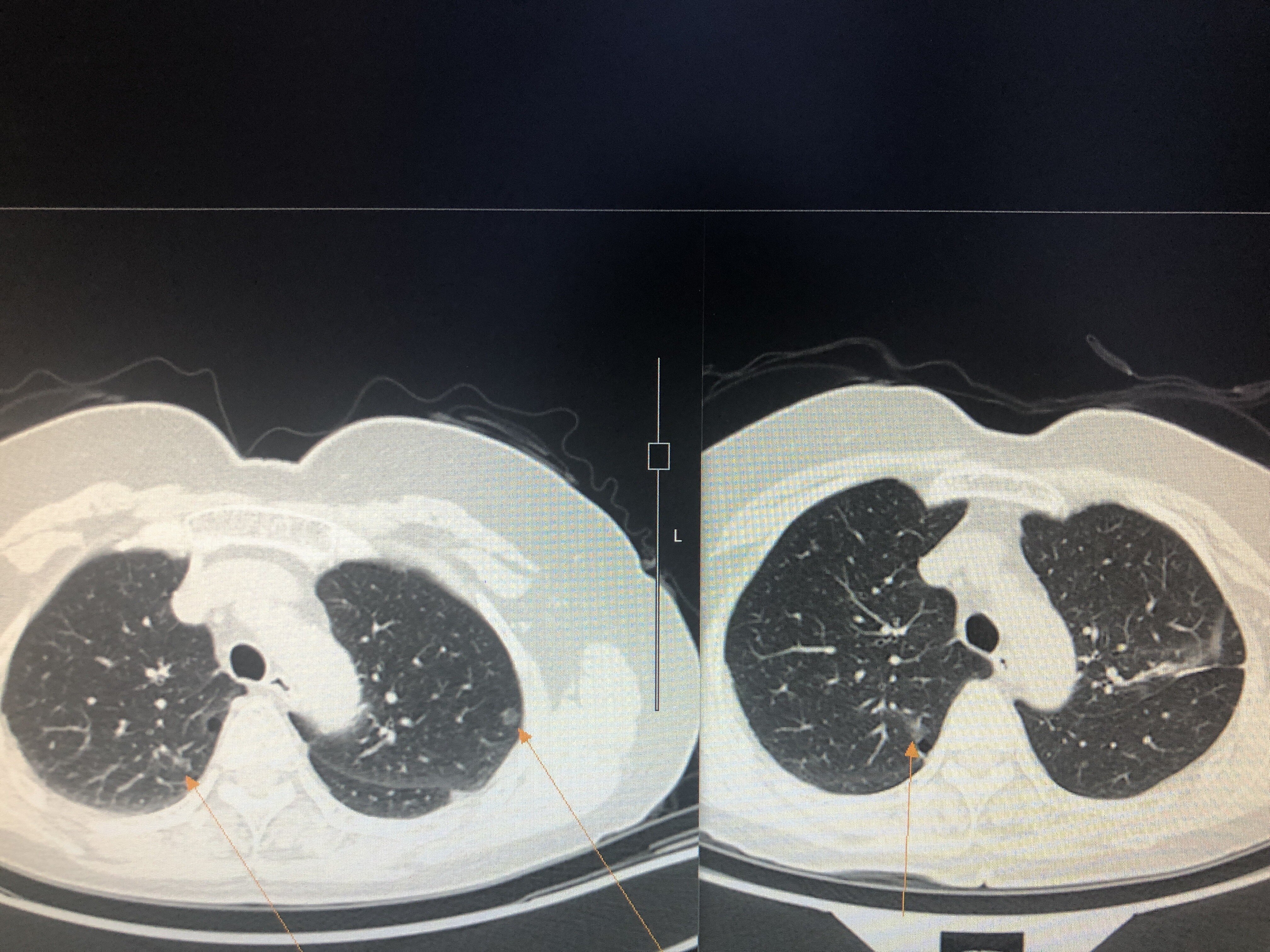 上肺微小磨玻璃結節,左上肺磨玻璃結節8-10mm,當時行左上肺楔形切除術