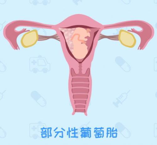 怀孕时剧烈呕吐?是葡萄胎惹的祸吗? 