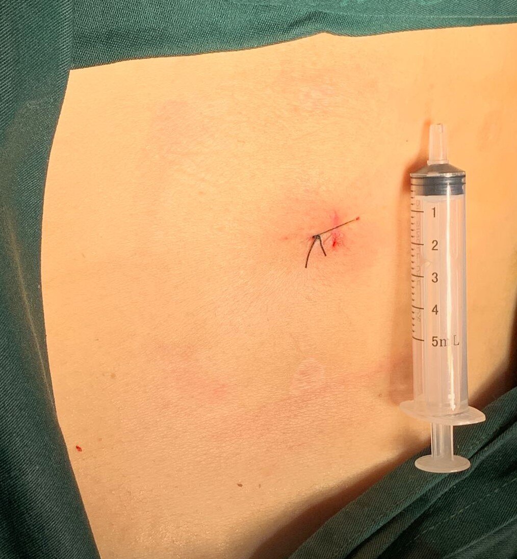 椎间孔镜微创手术治疗17岁青少年巨大腰椎间盘突出症 - 好大夫在线