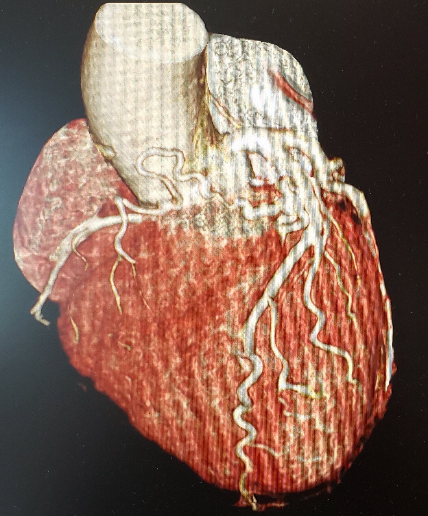 冠状动脉肺动脉瘘!_冠状动静脉瘘_介绍_症状表现 - 好大夫在线