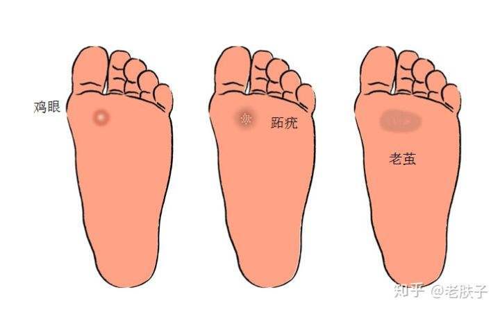 脚部疾病图片介绍图片
