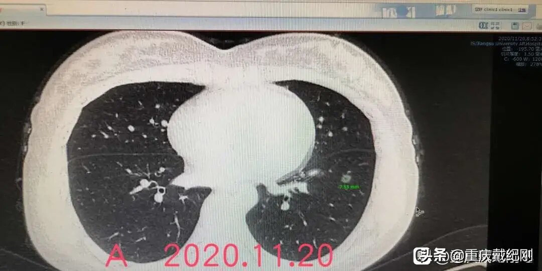 多發磨玻璃結節手術採取何種手術方式如何把握手術時機