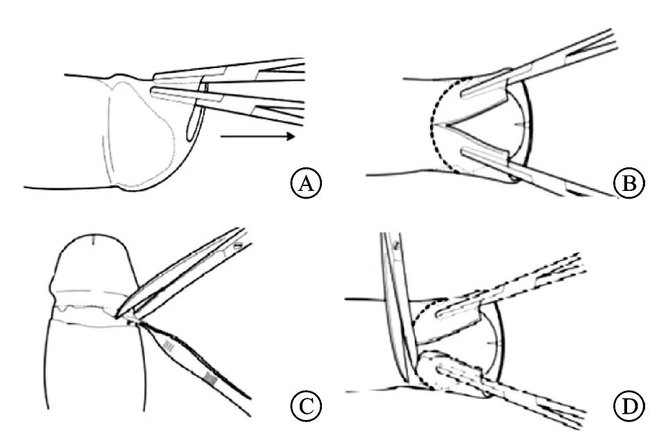 图3 背侧切开包皮环切术手术示意图该术式是针对成人的一种通用包皮环
