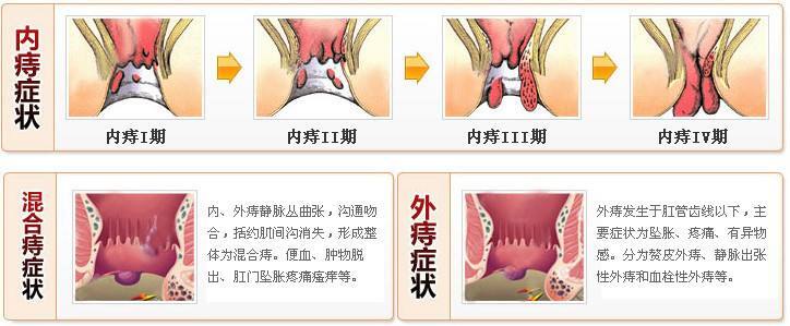 痔疮是怎样形成的图片