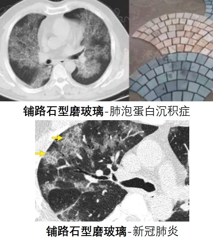 什么原因导致的肺部结节 y4YBAGBl5juAaM6aAAGMSM2yga4415.jpg?_ms_=4ca2