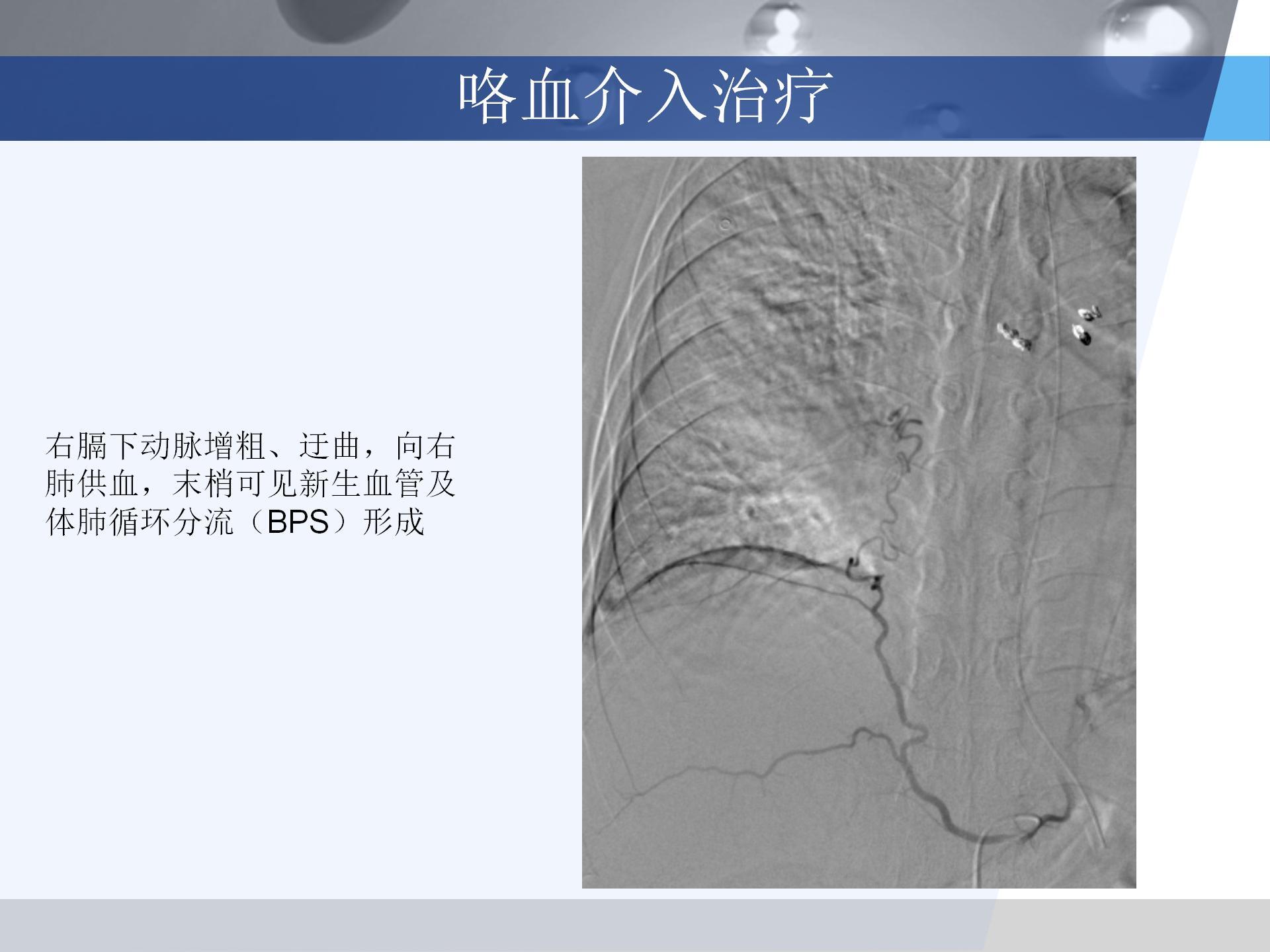 广医附一院-咯血病例汇报 [自动保存的]_07.jpg