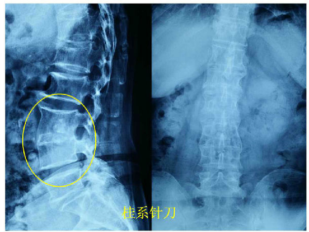 强直性脊柱炎竹节图片