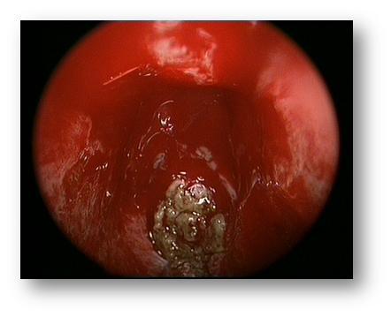 又称霉菌性鼻窦炎,是真菌在鼻腔,鼻窦内引起的一种感染性或变应性疾病