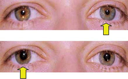 手电光双眼间持续运动照到健眼(右边眼),双眼瞳孔缩小照到患眼(左边眼