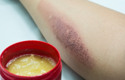 小面积烫伤怎么办 如何处理 烫伤 日常护理 用药 治疗方法 小面积烫伤怎么办 如何处理 烫伤 日常护理 用药 治疗方法