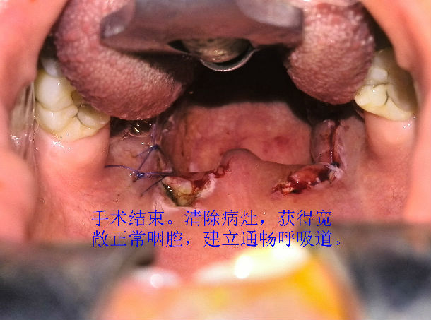 扁桃体手术开口器图片图片