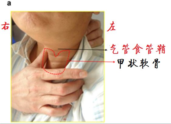 气管食管推移训练图片图片