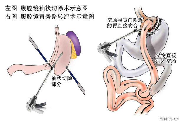 肥胖与糖尿病外科手术治疗的主要术式 (转载)