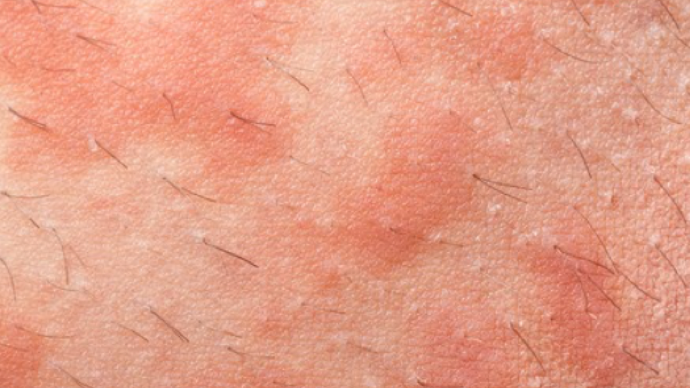 怎么辨别湿疹和汗疹 湿疹 症状 用药