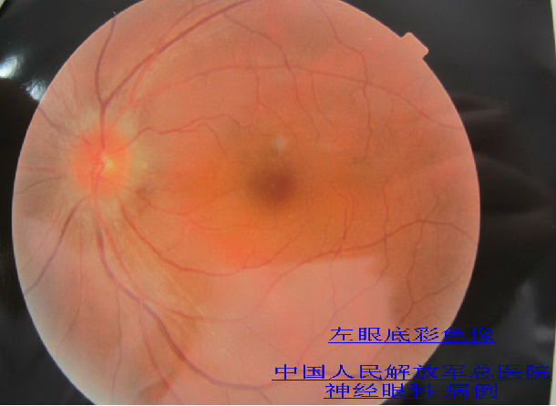 多发性硬化相关性视神经炎mson一例