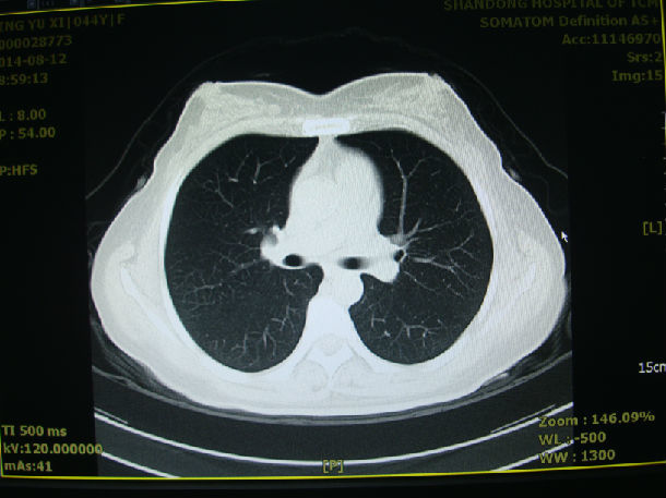 图1:正常肺部ct图2:肺间质纤维化图3:慢性阻塞性肺疾病合并肺纤维化图
