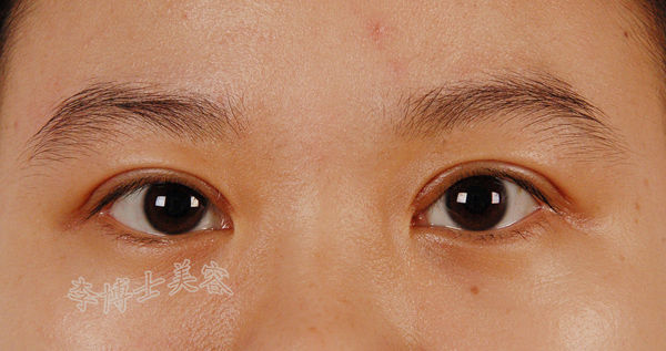 各种内眦赘皮的处理对策(即如何选择适当的开眼角方法) - 好大夫在线