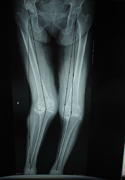 重度外翻畸形膝关节的外科治疗 