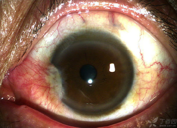 眼角膜白斑图片