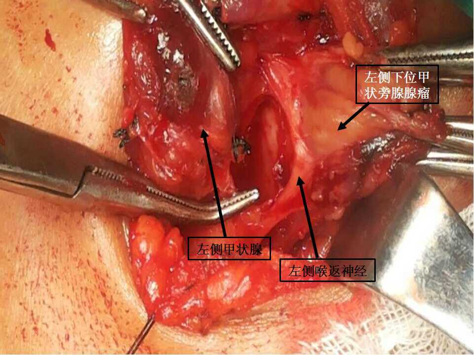 吉大一院王培松:下位甲状旁腺腺瘤手术中应特别注意喉返神经 