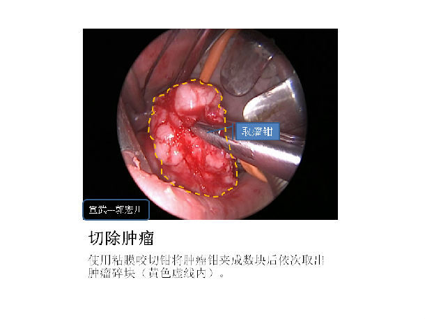 內鏡經口切除咽旁間隙頸靜脈孔海綿竇側壁神經纖維瘤病