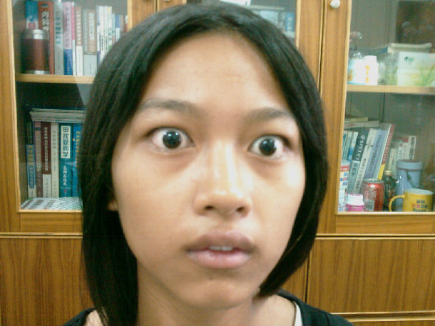 甲亢突眼治疗前后对比照