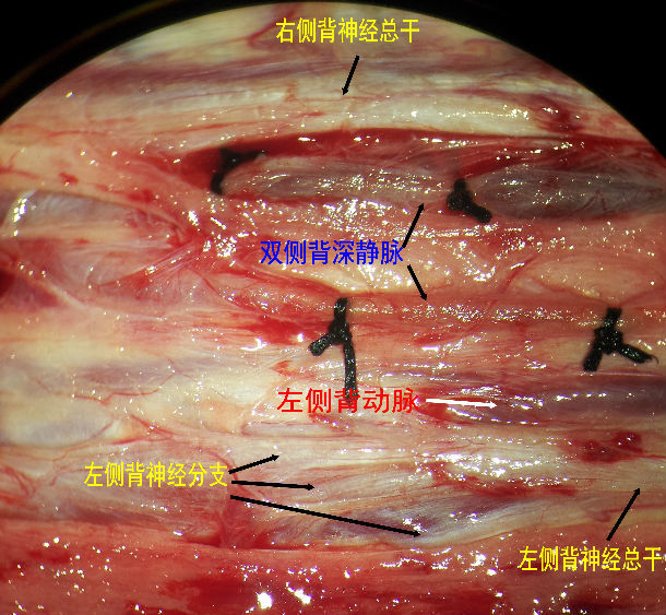 输精管吻合术图片