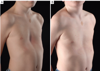 负压吸盘矫正是儿童漏斗胸治疗的第一选择_漏斗胸_治疗方法_治疗方式