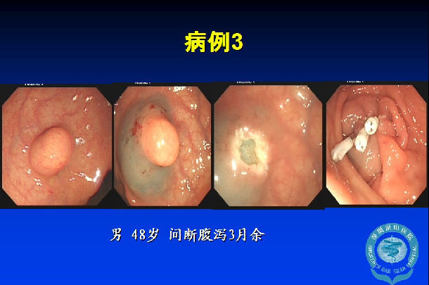 直肠类癌内镜下黏膜切除术(emr)