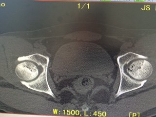 ct,核磁共振,病人左髖iiib,右髖iib期,ct看骨窗判斷股骨頭軟骨完整性