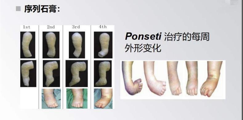 马蹄内翻足是什么