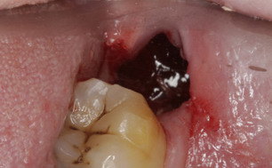 拔牙后牙窝状态图图片