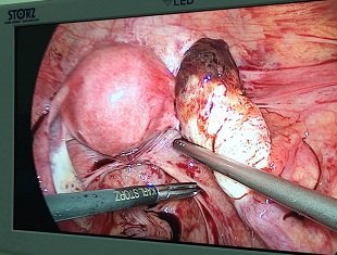 腹腔镜治疗卵巢妊娠一例 - 好大夫在线