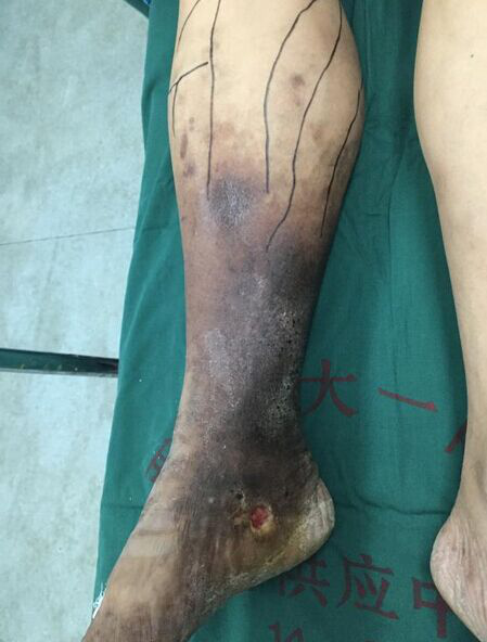 下肢静脉曲张会发黑,烂脚吗?——静脉曲张疑问5