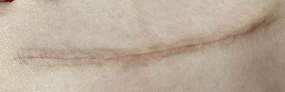 宫腔镜手术疤痕图图片