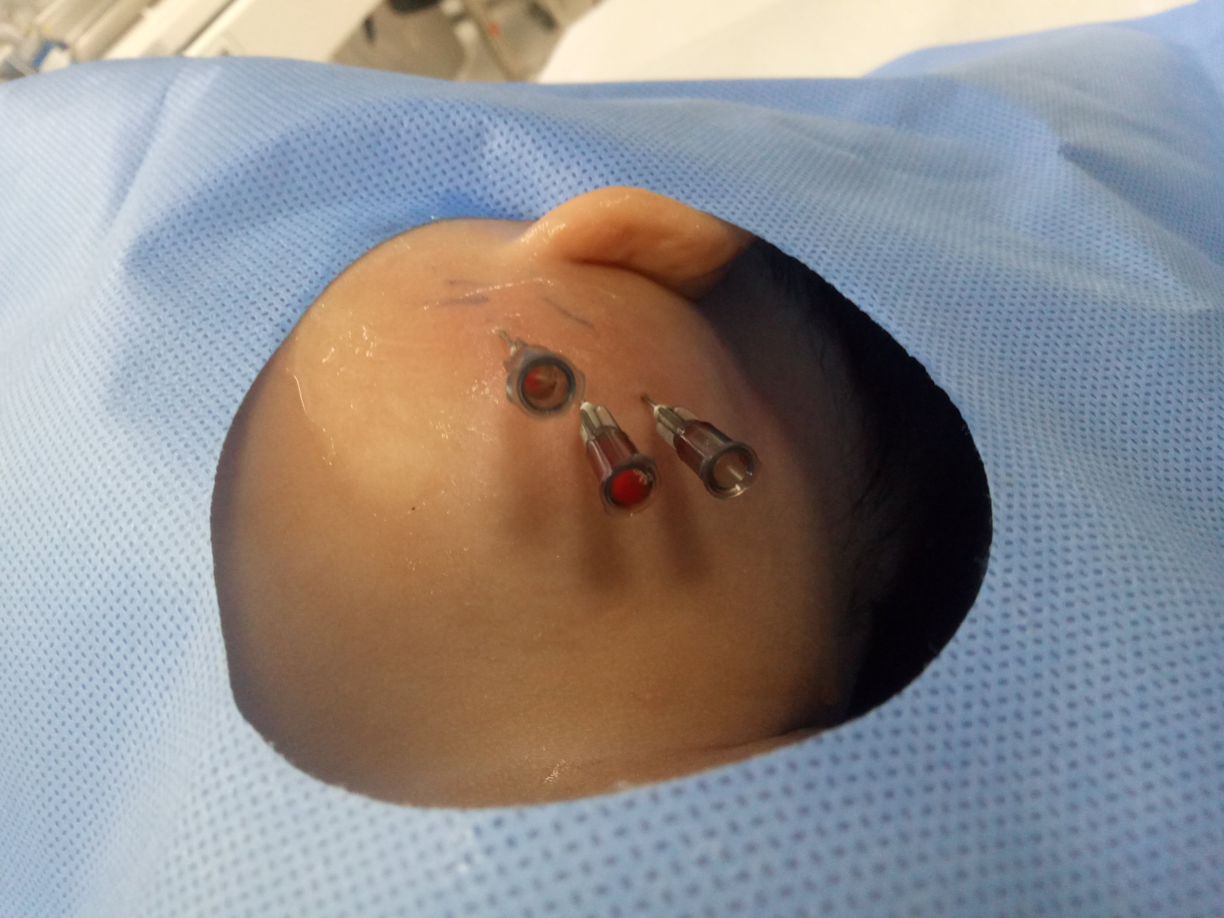 淋巴管畸形 - 好大夫在线