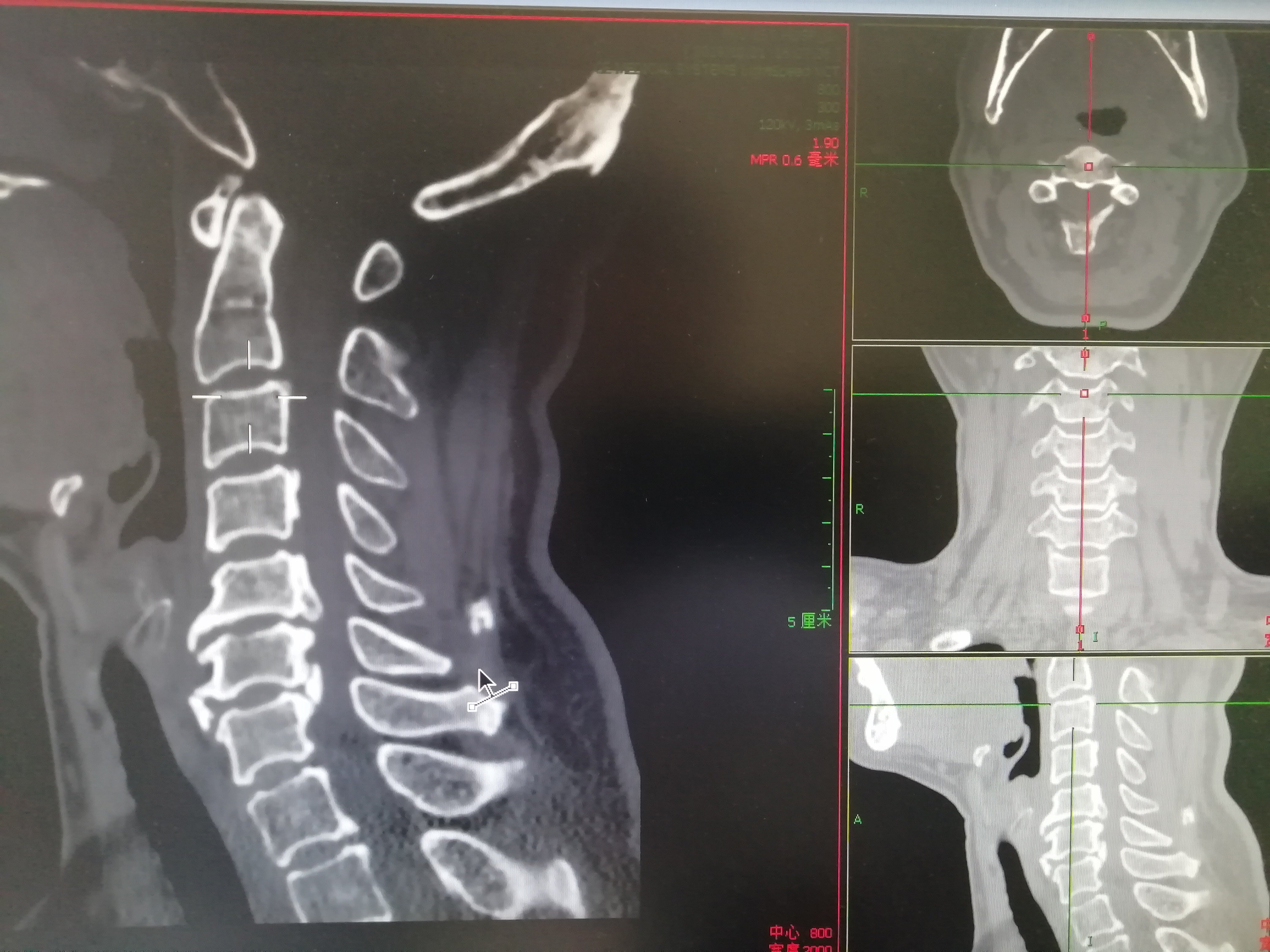 骨二科（脊柱关节中心）成功开展一例“骨质疏松性椎体压缩骨折椎体成形术（PVP）