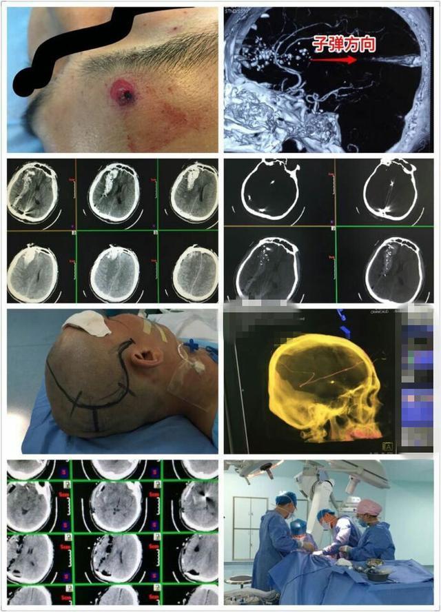 腾讯新闻:铁岭一男子楼道内头部离奇中枪 - 好大夫在线