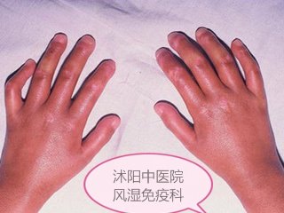 系统性硬化病(硬皮病)患者的日常注意事项