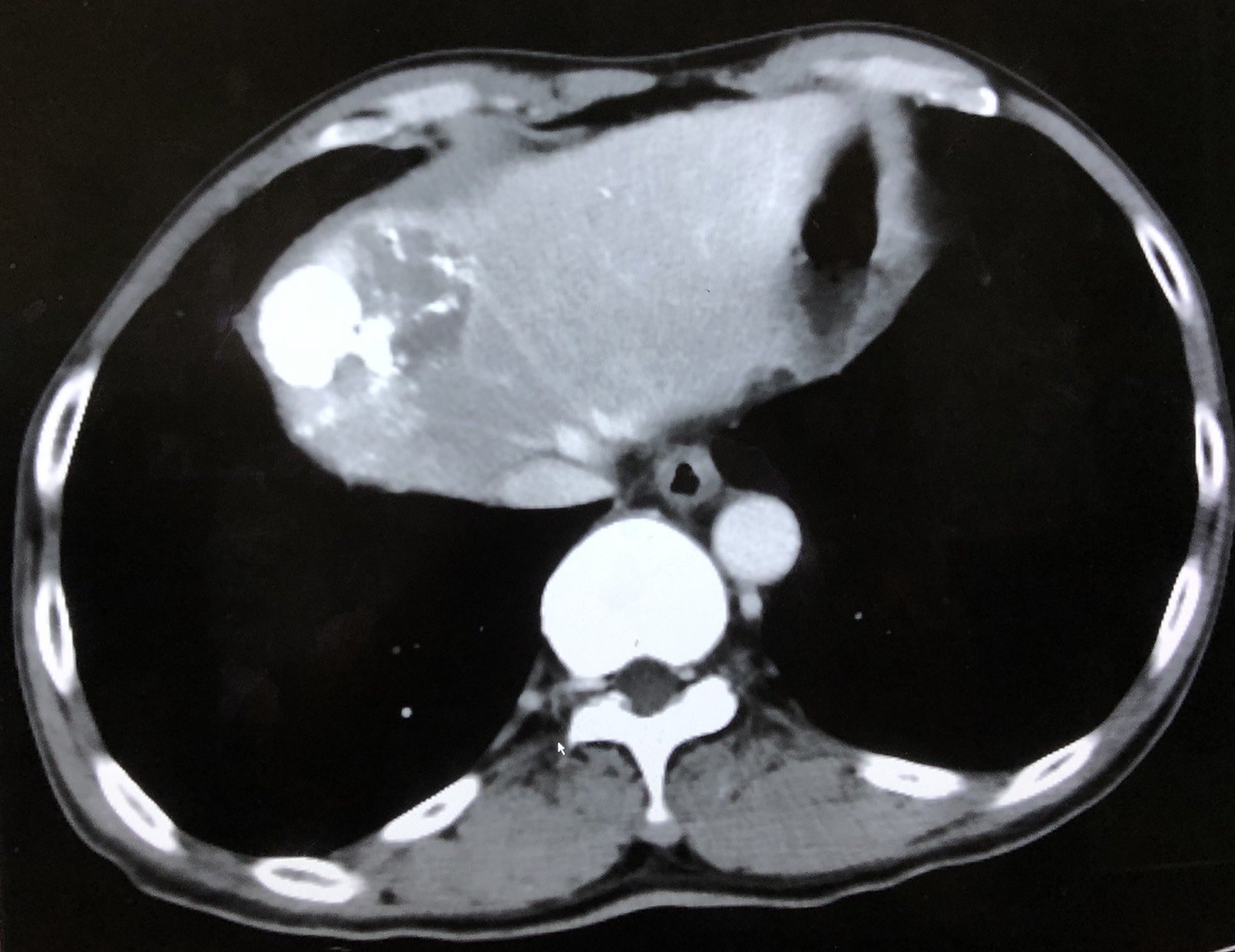 氩氦刀冷冻消融治疗膈顶肝癌案例分享 - 好大夫在线
