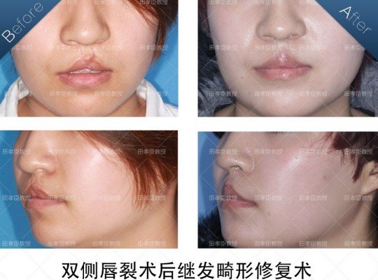 关于唇腭裂二期手术修复的最佳时间