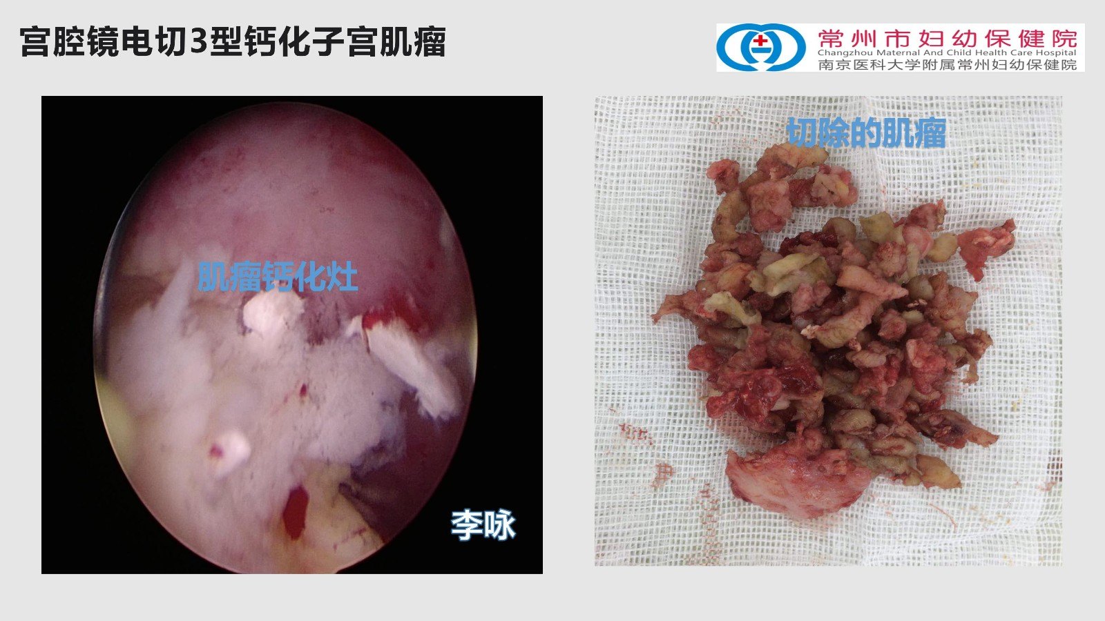 宫腔镜电切钙化肌瘤图片_01.jpg